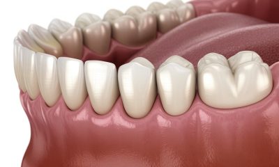 découvrez les caractéristiques de la céramique dentaire capdentaire et apprenez à choisir la meilleure option pour un rendu naturel et esthétique de votre sourire.