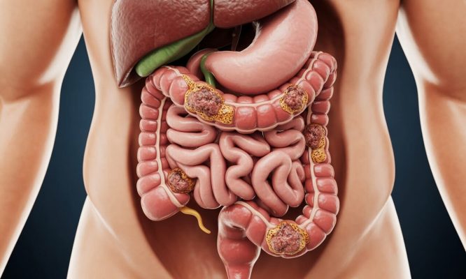 découvrez le processus d'évolution du cancer du côlon, depuis les lésions locales jusqu'à l'insuffisance organique, et comprenez les mécanismes menant au décès.