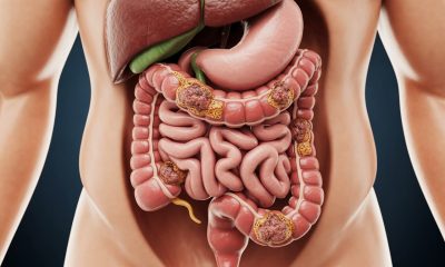 découvrez le processus d'évolution du cancer du côlon, depuis les lésions locales jusqu'à l'insuffisance organique, et comprenez les mécanismes menant au décès.